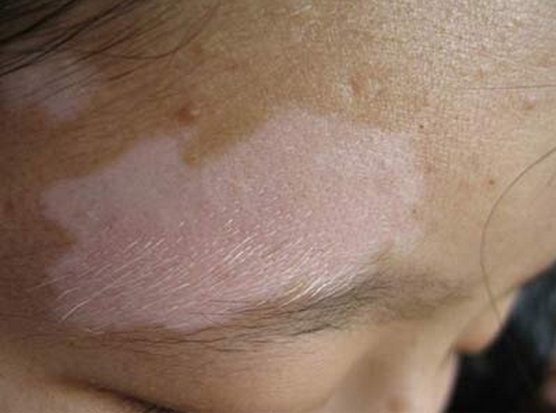 白癜风患者如何调节心理压力呢