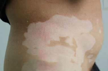 白癜风反复发作会带来哪些危害