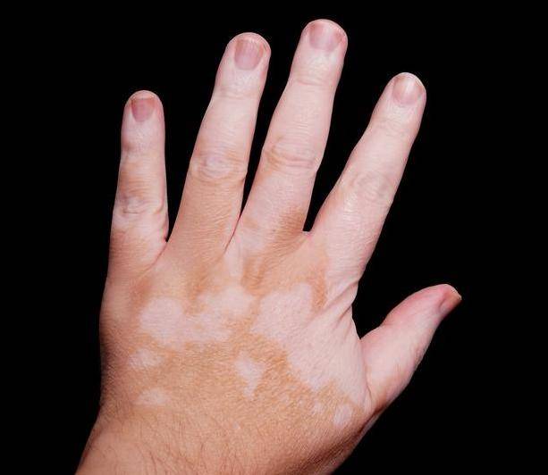 手部的白癜风是怎么回事