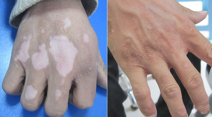 为什么白癜风病况会反反复复