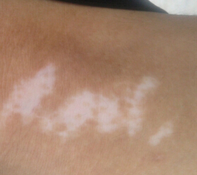 身上出现白斑是怎么回事