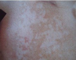 白癜风疾病对身体有影响吗