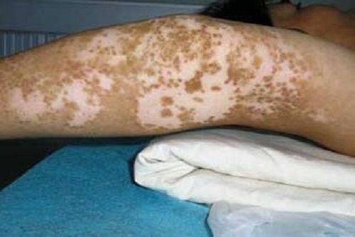 白癜风的黑色素是怎样产生的