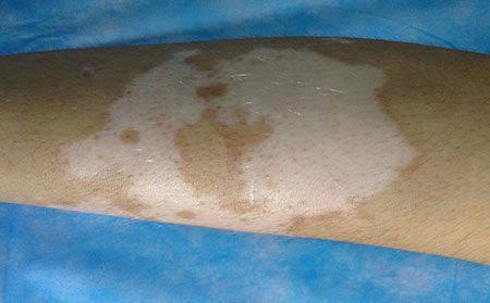 患者在什么情况下染上了白癜风